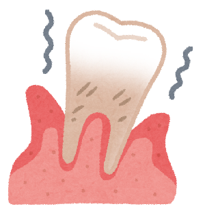 歯周病により病気になった歯茎と、ぐらぐらになってしまった歯のイラストです。