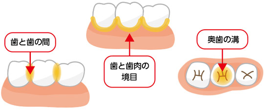 プラークの付きやすいところについての画像